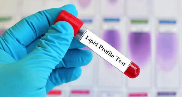 Lipid Profile Tests